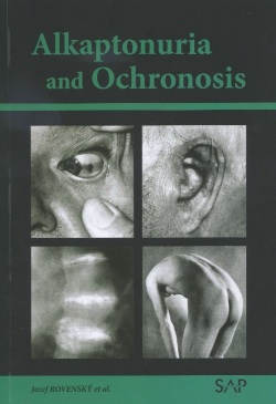 Alkaptonuria and ochronosi (Jozef Rovenský)